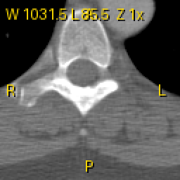 CT with contrast x2 and brightness +50 from the default window