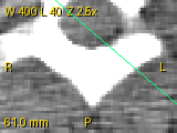 CT (pydicom CT_small): zoom 2.5, pan, W 400 L 40, measurement in mm