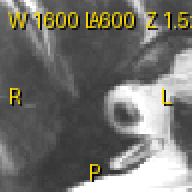 MR (pydicom MR_small): window from WindowCenter/WindowWidth tags